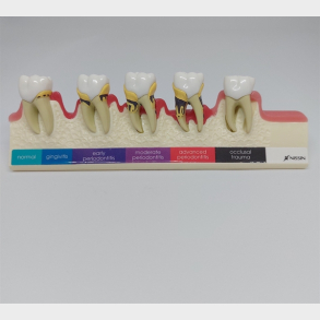 Parodontitis Studiemodel 